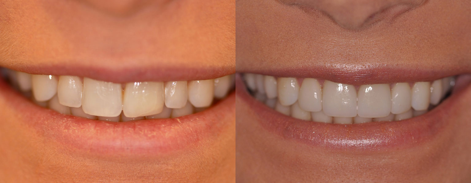 Before & After Porcelain Veneers