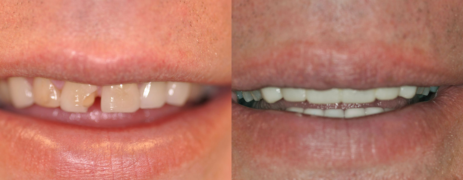 Before & After Anterior Crowns