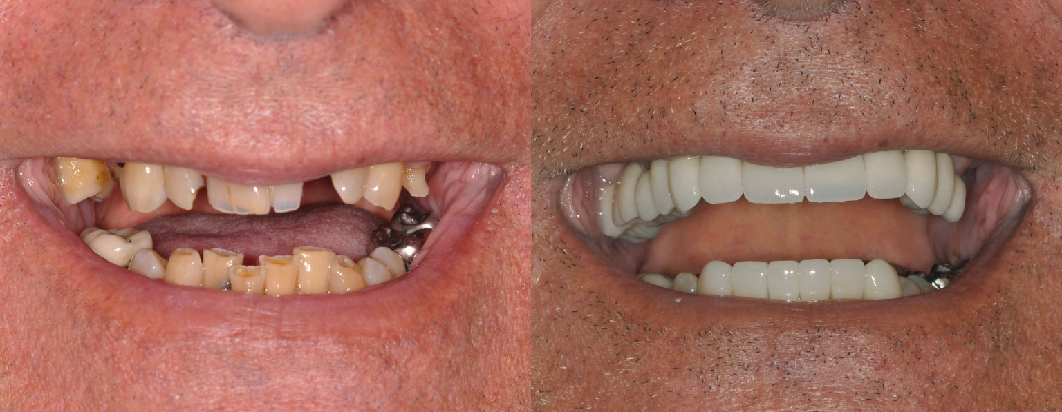 Before & After Full Mouth Smile Makeover