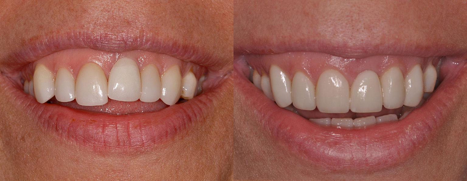 Before & After PatientPorcelain Veneers and Dental Implant Crown