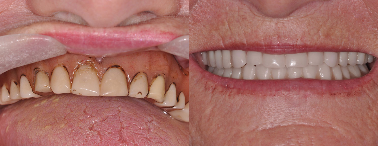 Before & After New Upper and Lower Dentures