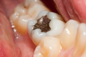 Metal Filling in Tooth