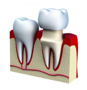 Dental crown installation process,