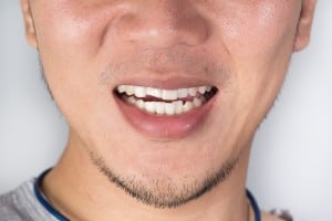 Teeth Injuries or Teeth Breaking in Male