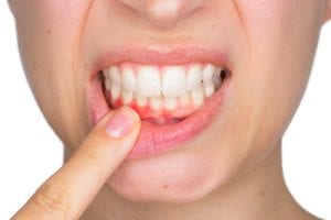 portrait of young woman showing with his finger inflamed lower gingiva with pain expression-img-blog