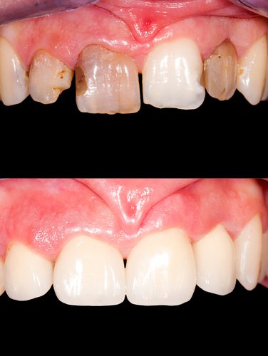 frontal teeth restoration with ceramic crowns, before- after-img-blog