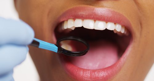 black woman opening her mouth for the dentist-img-blog