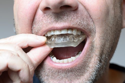 Man Placing Bite Plate in his Mouth