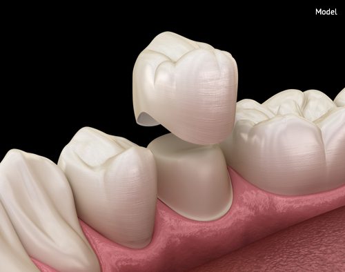 dental crown premolar tooth assembly process