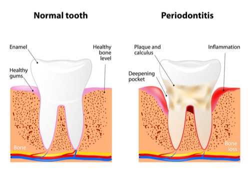 Image of a normal, healthy tooth compared to a tooth affected by periodontitis-img-blog